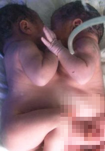 سوريا: ولادة توأمين ملتصقين في البطن والصدر!  صورة رقم 1