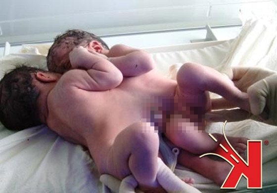 سوريا: ولادة توأمين ملتصقين في البطن والصدر!  صورة رقم 2