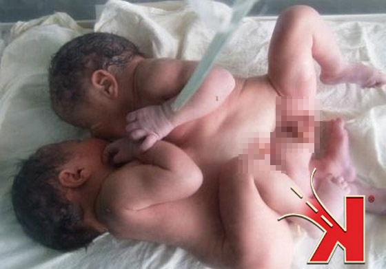 سوريا: ولادة توأمين ملتصقين في البطن والصدر!  صورة رقم 5