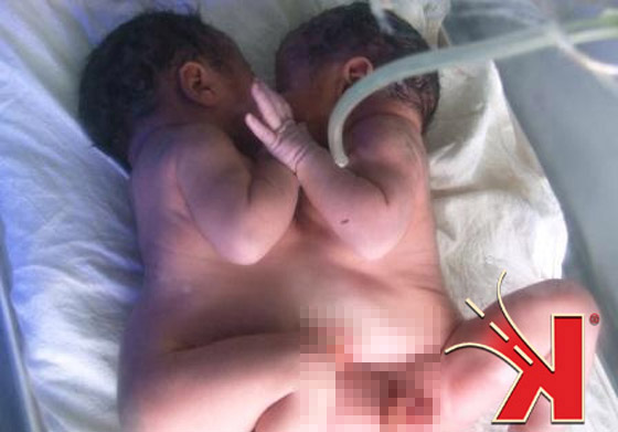 سوريا: ولادة توأمين ملتصقين في البطن والصدر!  صورة رقم 3