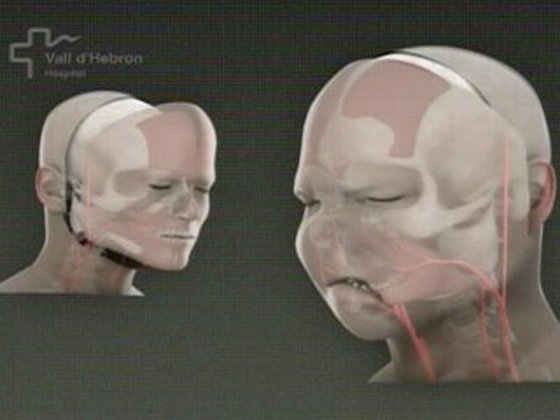 أطباء إسبانيا يجرون أول عملية لزرع وجه كامل في العالم  صورة رقم 4