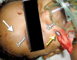 جدة: فريق طبي ينجح في استخراج كرة معدنية اخترقت جمجمة طفل!! صورة رقم 1
