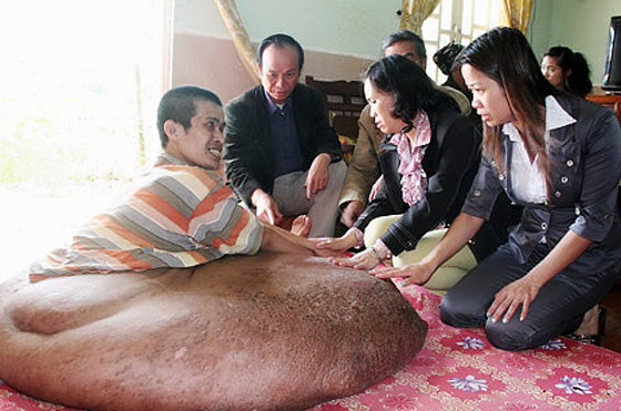 فيتنامي يعاني من أكبر ورم في العالم برجله يزن 80 كلغم   صورة رقم 3