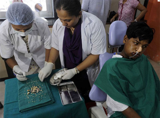 اطباء يقتلعون 232 سنا من فم شاب هندي يبلغ 17 عاما صورة رقم 2