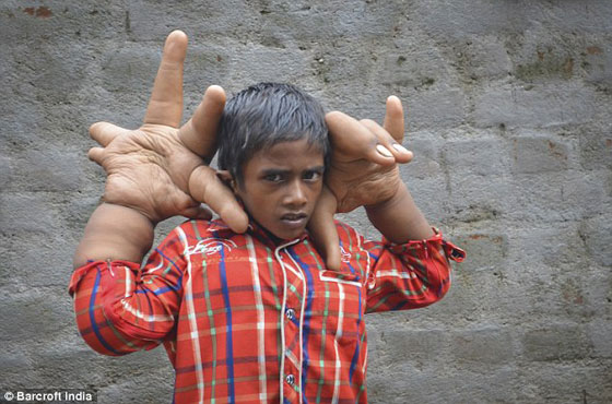 يدا طفل هندي تتضخمان بحجم عملاق.. كل يد منهما تزن 8 كيلوغرامات صورة رقم 1