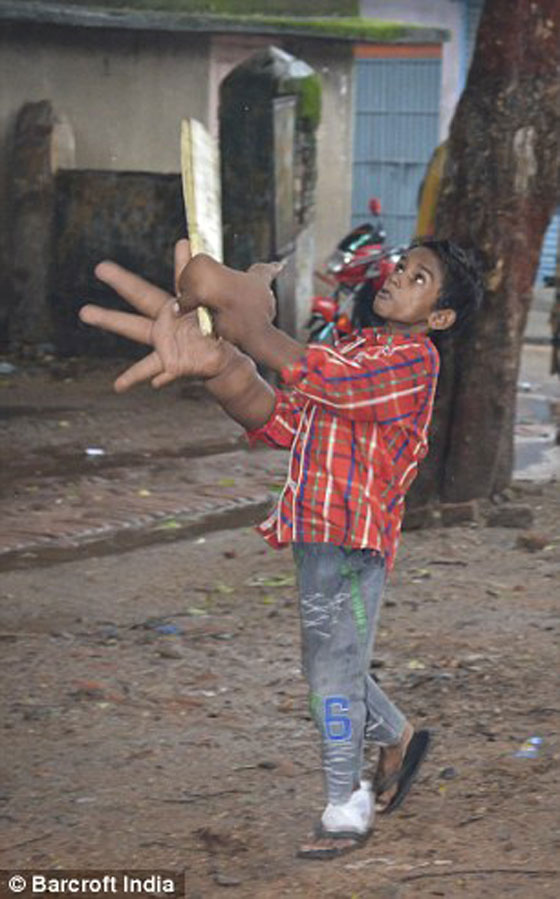 يدا طفل هندي تتضخمان بحجم عملاق.. كل يد منهما تزن 8 كيلوغرامات صورة رقم 3
