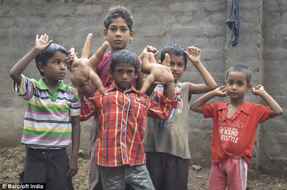 يدا طفل هندي تتضخمان بحجم عملاق.. كل يد منهما تزن 8 كيلوغرامات صورة رقم 9