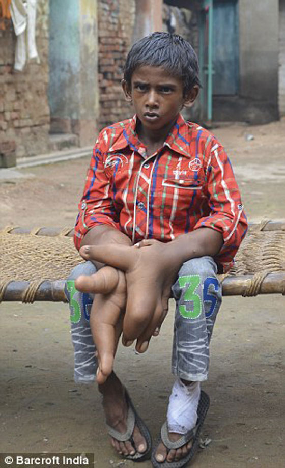 يدا طفل هندي تتضخمان بحجم عملاق.. كل يد منهما تزن 8 كيلوغرامات صورة رقم 5