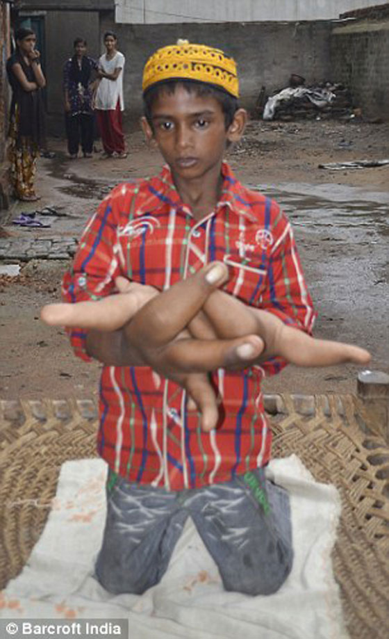 يدا طفل هندي تتضخمان بحجم عملاق.. كل يد منهما تزن 8 كيلوغرامات صورة رقم 6
