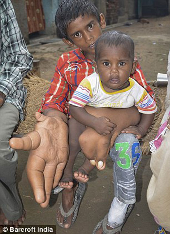 يدا طفل هندي تتضخمان بحجم عملاق.. كل يد منهما تزن 8 كيلوغرامات صورة رقم 13