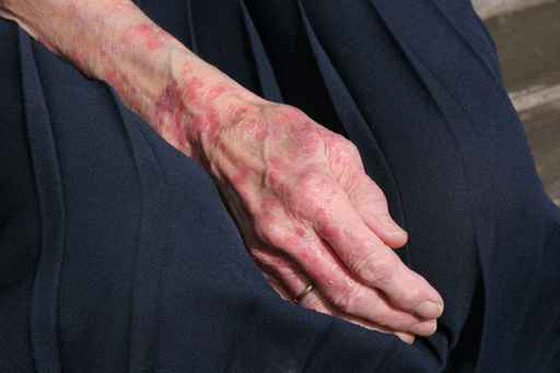 احذر من 5 علامات على الجلد تكشف امراضا خطيرة قبل ظهورها صورة رقم 1