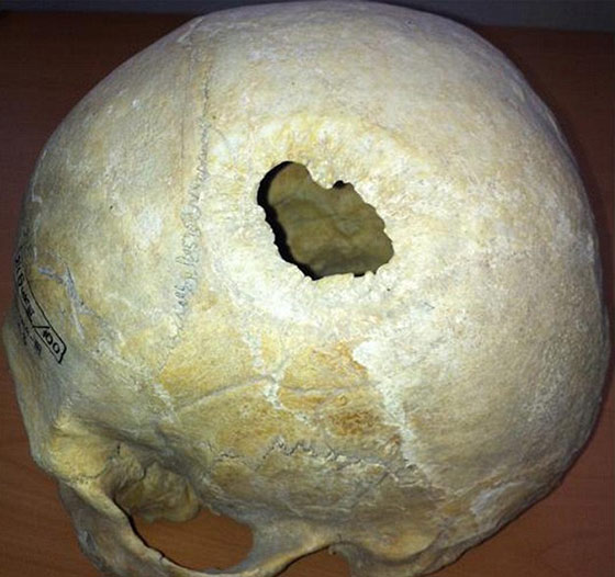 بالصور.. جمجمة بشرية تثبت ان القدماء برعوا في جراحة المخ صورة رقم 4
