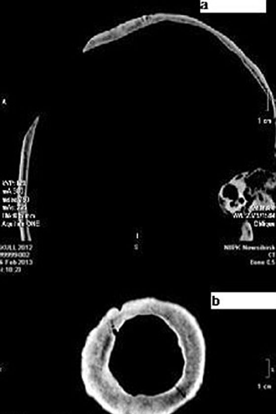 بالصور.. جمجمة بشرية تثبت ان القدماء برعوا في جراحة المخ صورة رقم 3