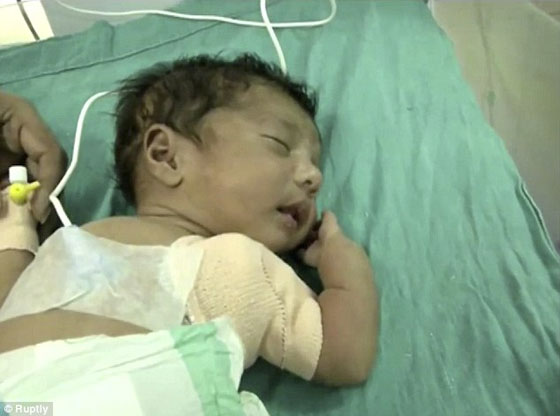 صور وفيديو طفل هندي وُلد مع ثلاث أذرع  صورة رقم 4