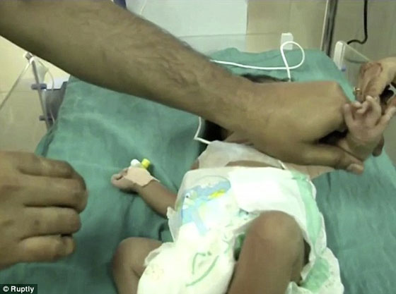 صور وفيديو طفل هندي وُلد مع ثلاث أذرع  صورة رقم 3