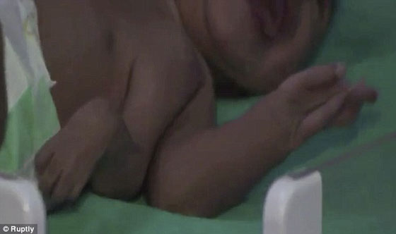 صور وفيديو طفل هندي وُلد مع ثلاث أذرع  صورة رقم 2