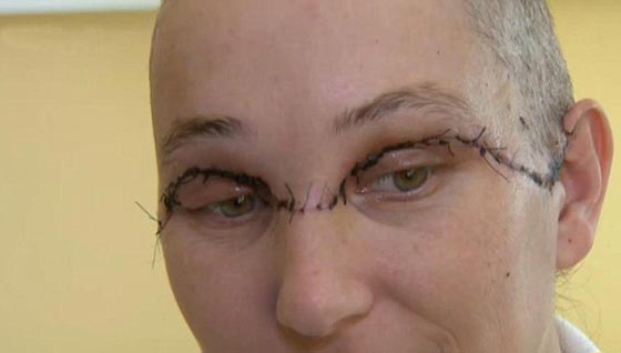بالصور.. امرأة تفقد شعرها، حاجبيها ورموشها بصعقة كهربائية مدمرة صورة رقم 4