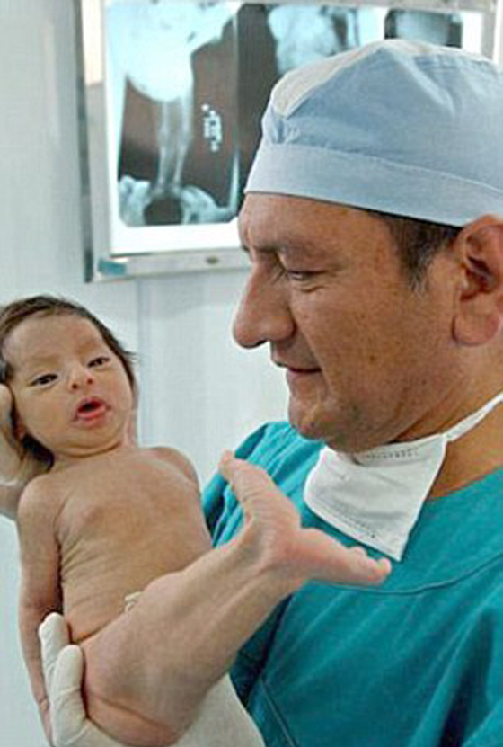 ولادة طفل يشبه حورية البحر بسبب التصاق الجزء السفلي من جسمه صورة رقم 2