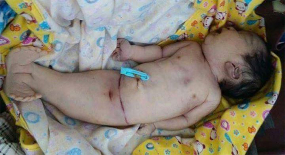 ولادة طفل يشبه حورية البحر بسبب التصاق الجزء السفلي من جسمه صورة رقم 1