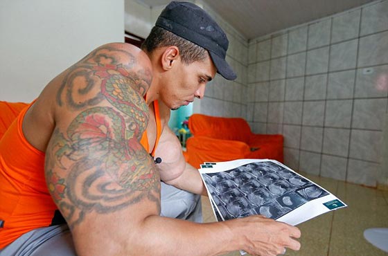 فيديو وصور برازيلي يحقن عضلاته بالزيت والكحول ويعرّض ذراعيه لخطر البتر صورة رقم 7