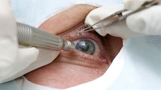 بشرى للملايين.. علاج جديد لاعتام العين بالقطرة بدل الجراحة صورة رقم 2
