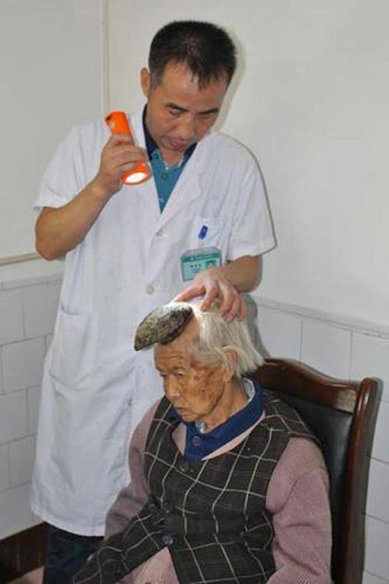 صور حالة نادرة تحير اطباء الصين: امرأة وحيد القرن!! صورة رقم 2