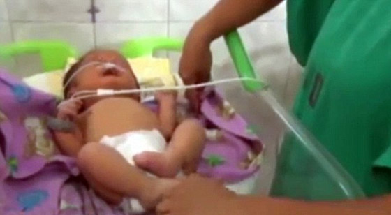 طفل يولد بانبوبي تنفس بدل الأنف في بيرو.. والاطباء يطمئنون صورة رقم 1