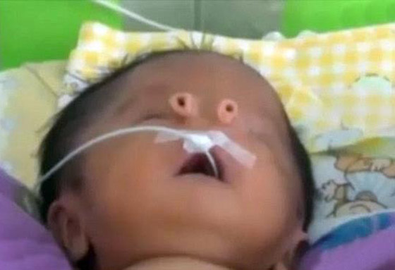 طفل يولد بانبوبي تنفس بدل الأنف في بيرو.. والاطباء يطمئنون صورة رقم 2
