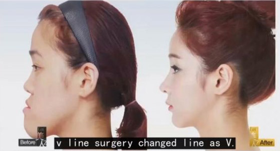  عمليات التجميل في كوريا تحوّل ابشع الفتيات الى ملكات جمال: فيديو قبل وبعد! صورة رقم 4