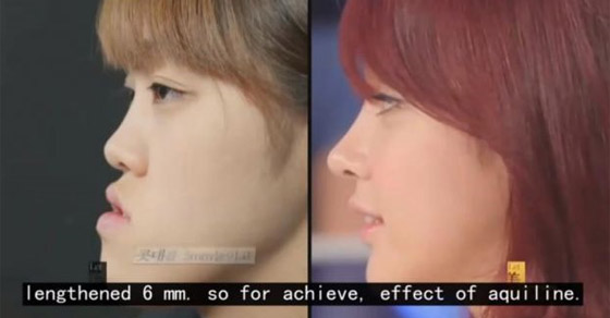  عمليات التجميل في كوريا تحوّل ابشع الفتيات الى ملكات جمال: فيديو قبل وبعد! صورة رقم 5