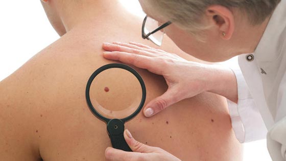 اكتشاف دواء جديد يقضي على سرطان الجلد صورة رقم 1