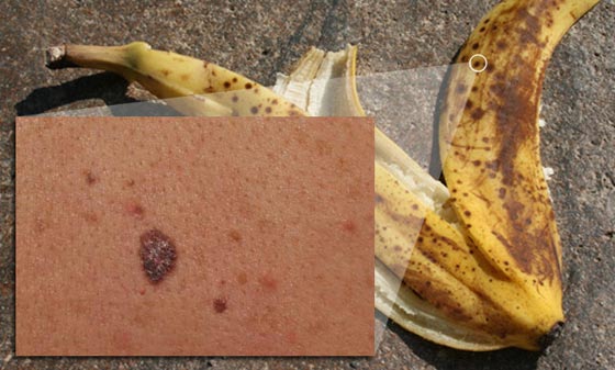 مراقبة  قشور الموز المتعفنة تكشف عن علاج لسرطان الجلد صورة رقم 1