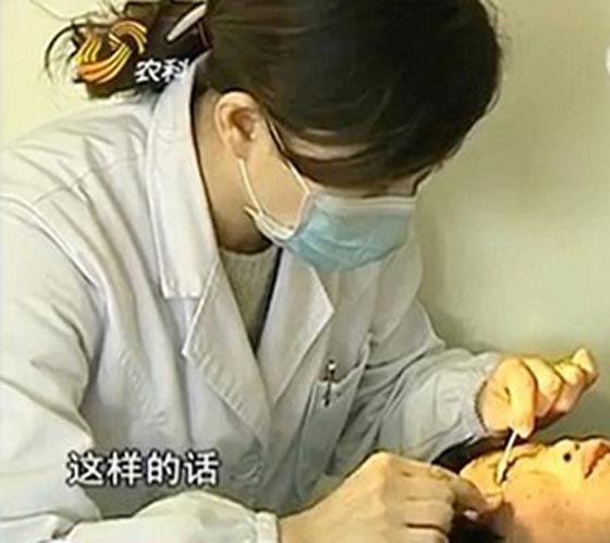 فيديو وصور امرأة صينية تذرف حجارة كبيرة من عينيها بدل الدموع صورة رقم 3