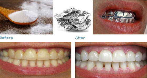 اسأل مجرّب: تبييض الأسنان مع ورق الألمنيوم لتصبح ناصعة البياض!  صورة رقم 1
