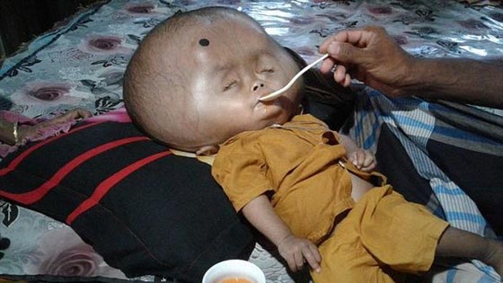 بنغلايدش: راس طفل يتضخم ليصبح بحجم كرة قدم!! صورة رقم 1