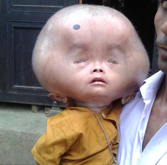 بنغلايدش: راس طفل يتضخم ليصبح بحجم كرة قدم!! صورة رقم 2