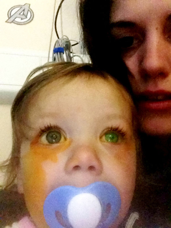 حادث رهيب.. مسحوق الغسيل يشوه  وجه طفلة بنسبة 95%  صورة رقم 1