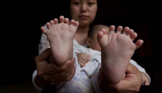 حالة نادرة.. ولادة طفل صيني بـ 31 اصبعا صورة رقم 1