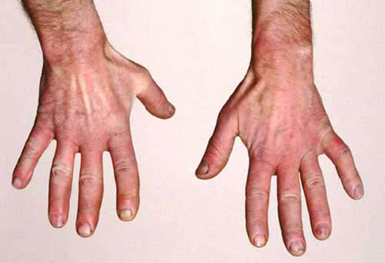 هل تعاني من برودة أصابع اليدين في الشتاء؟ السبب قد يكون خطيرا! صورة رقم 3