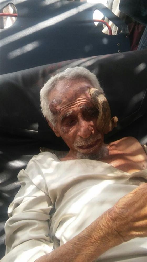رجل يمني يعيش مع قرن شيطاني في جبينه.. صور صورة رقم 1