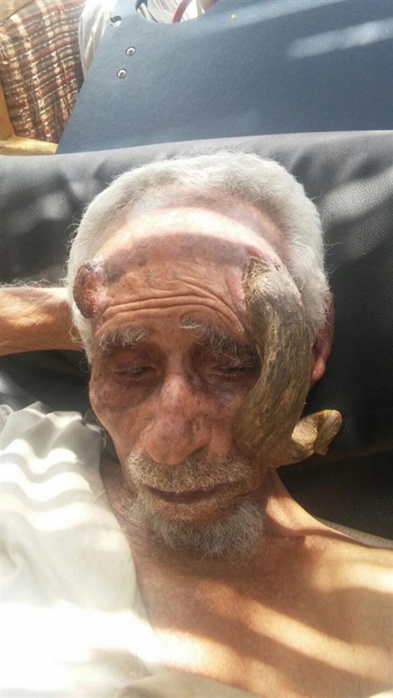 رجل يمني يعيش مع قرن شيطاني في جبينه.. صور صورة رقم 2