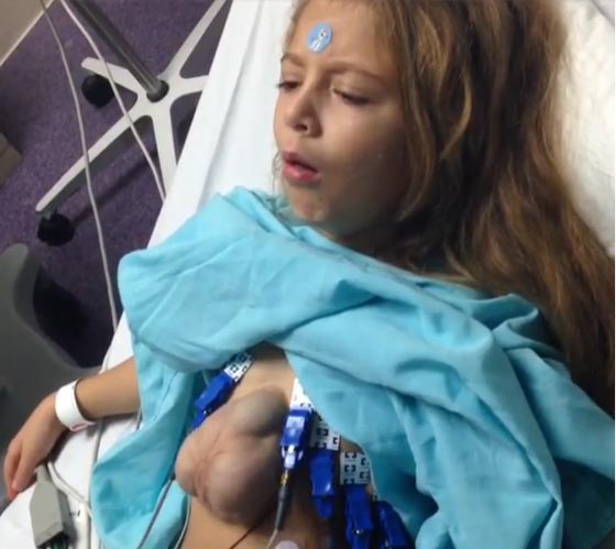 فيديو وصور.. طفلة تعيش بقلب ينبض خارج صدرها في حالة نادرة صورة رقم 14