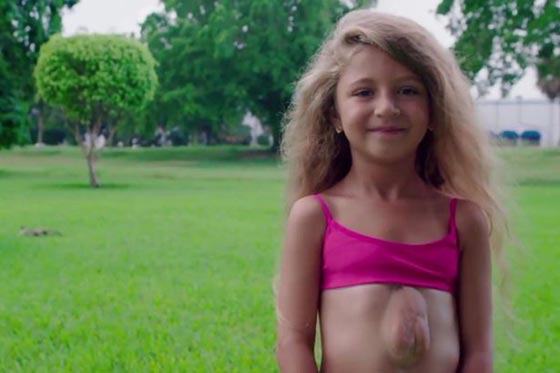 فيديو وصور.. طفلة تعيش بقلب ينبض خارج صدرها في حالة نادرة صورة رقم 2