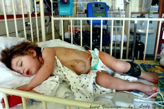 فيديو وصور.. طفلة تعيش بقلب ينبض خارج صدرها في حالة نادرة صورة رقم 5