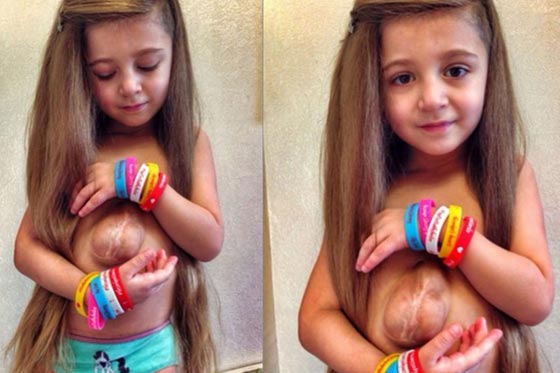 فيديو وصور.. طفلة تعيش بقلب ينبض خارج صدرها في حالة نادرة صورة رقم 6