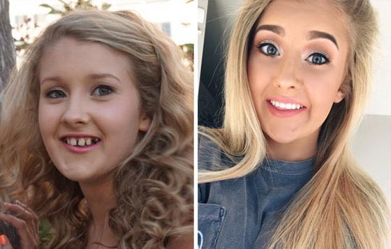 صور مدهشة لأشخاص قبل وبعد استخدام تقويم الأسنان صورة رقم 1