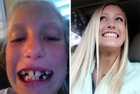 صور مدهشة لأشخاص قبل وبعد استخدام تقويم الأسنان صورة رقم 2