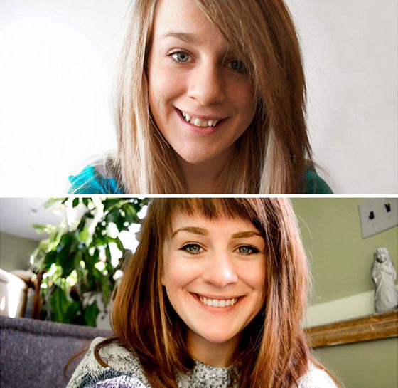 صور مدهشة لأشخاص قبل وبعد استخدام تقويم الأسنان صورة رقم 3
