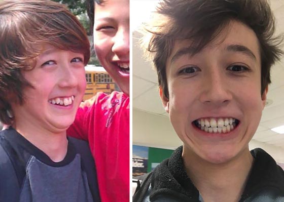 صور مدهشة لأشخاص قبل وبعد استخدام تقويم الأسنان صورة رقم 7