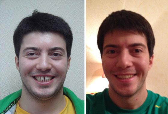 صور مدهشة لأشخاص قبل وبعد استخدام تقويم الأسنان صورة رقم 8